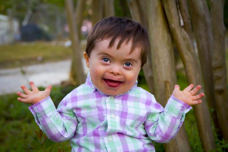 kids with translocation down syndrome