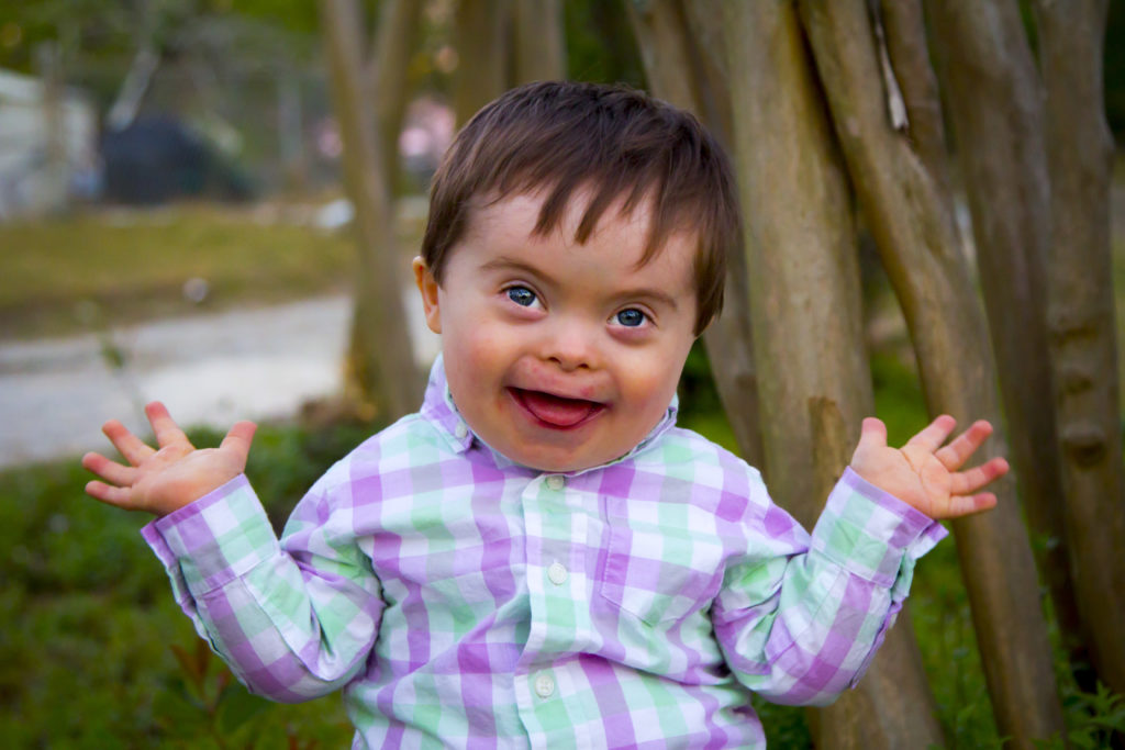 Do Down Syndrome Babies Have Short Legs At Barbara Middleton Blog